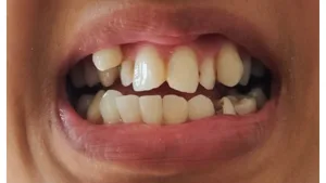 People with misaligned teeth often face greater...